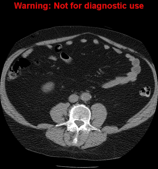 File:Bosniak renal cyst - type IV (Radiopaedia 23402-23466 Axial non-contrast 20).jpg