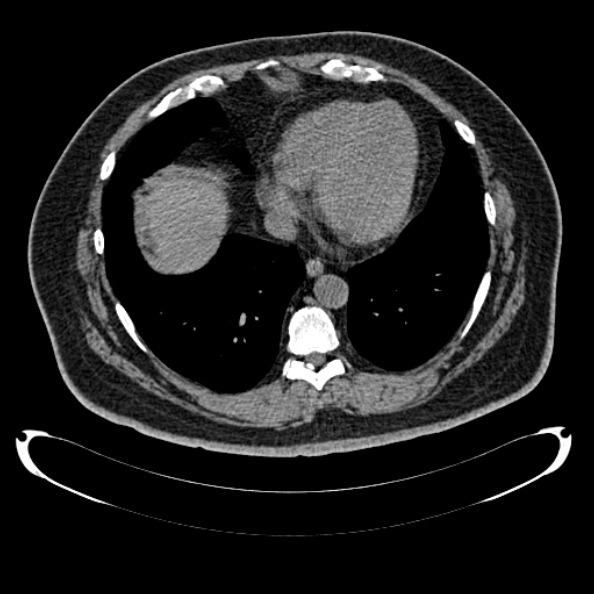 Bosniak renal cyst - type IV (Radiopaedia 24244-24518 Axial non-contrast 11).jpg