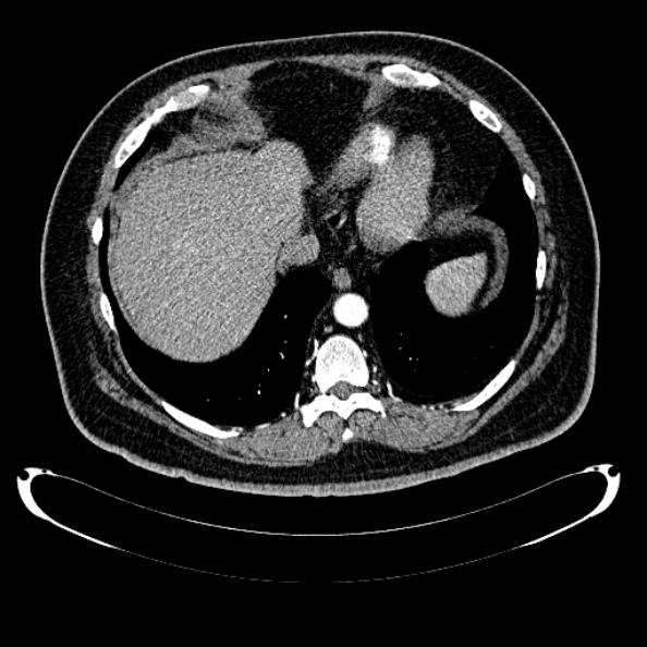 Bosniak renal cyst - type IV (Radiopaedia 24244-24518 B 26).jpg