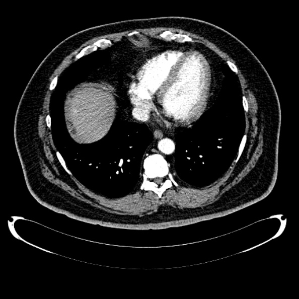 Bosniak renal cyst - type IV (Radiopaedia 24244-24518 B 7).jpg