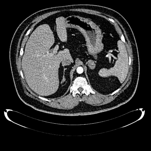 Bosniak renal cyst - type IV (Radiopaedia 24244-24518 B 75).jpg