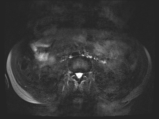 Bouveret syndrome (Radiopaedia 61017-68856 Axial MRCP 49).jpg