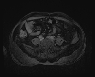 Bouveret syndrome (Radiopaedia 61017-68856 Axial T1 C+ fat sat 71).jpg