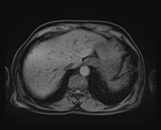 Bouveret syndrome (Radiopaedia 61017-68856 Axial T1 fat sat 13).jpg