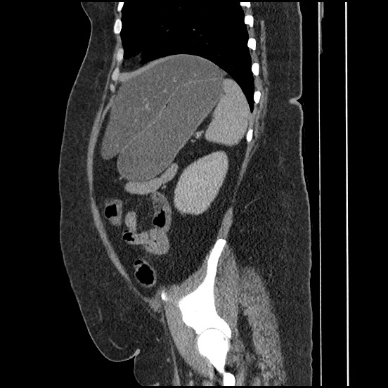 Bowel and splenic infarcts in acute lymphocytic leukemia (Radiopaedia 61055-68913 C 26).jpg