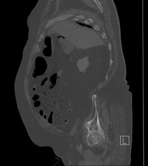 File:Bowel ischemia secondary to SMA occlusion with extensive portomesenteric venous gas (Radiopaedia 54656-60871 Sagittal bone window 89).jpg