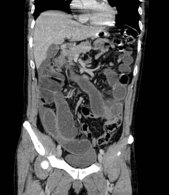 Bowel obstruction from colon carcinoma (Radiopaedia 22995-23028 C 28).jpg