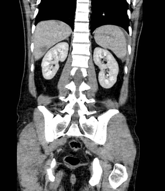 Bowel obstruction from colon carcinoma (Radiopaedia 22995-23028 C 55).jpg