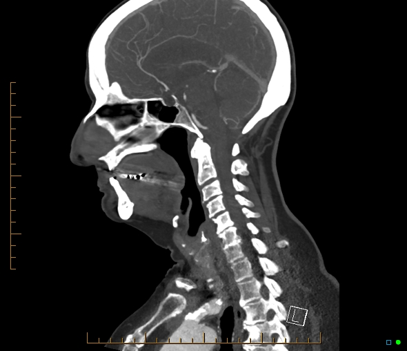 Brachiocephalic trunk stenosis (Radiopaedia 87242-103519 C 34).jpg