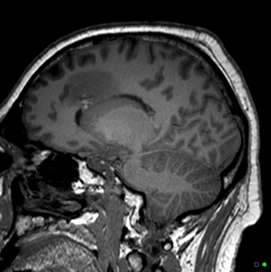 Brain death on MRI and CT angiography (Radiopaedia 42560-45689 Sagittal T1 11).jpg