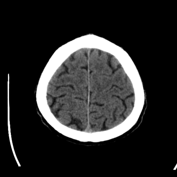 Brain metastases from lung cancer (Radiopaedia 24480-24781 Axial non-contrast 43).jpg