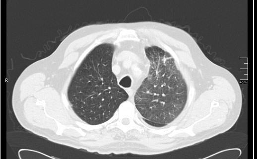 Brain metastases from squamocellular lung cancer (Radiopaedia 56515-63219 Axial lung window 19).jpg