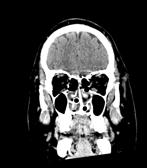 Brainstem hemorrhage (Radiopaedia 81294-94976 Coronal non-contrast 14).jpg