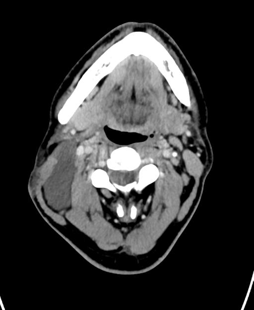 Branchial cleft cyst (Radiopaedia 31167-31875 Axial C+ delayed 23).jpg