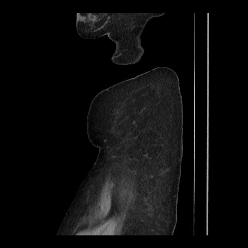 Breast cancer pseudocirrhosis (Radiopaedia 65406-74454 C 31).jpg