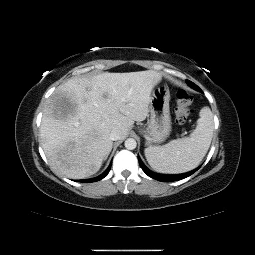 File:Breast cancer pseudocirrhosis after chemotherapy (Radiopaedia 65407-74456 Axial 19).jpg