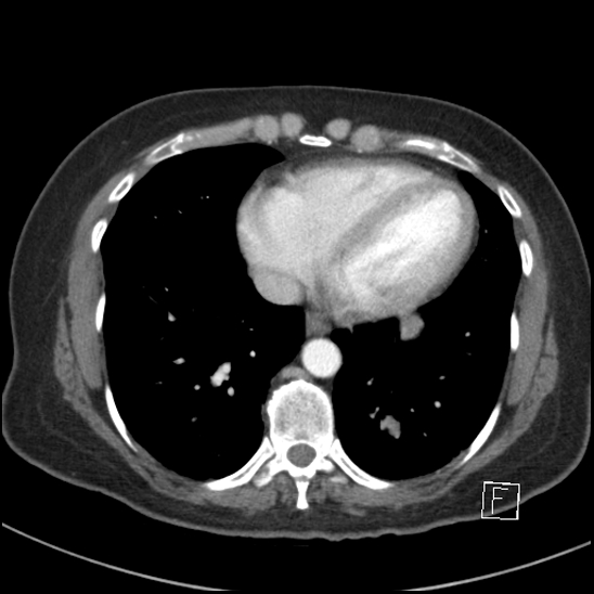 Breast metastases from renal cell cancer (Radiopaedia 79220-92225 A 66).jpg