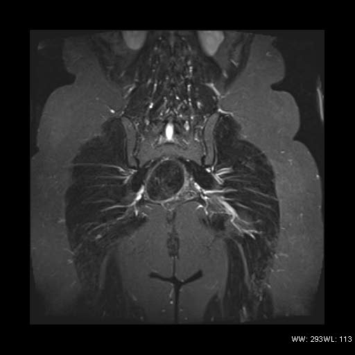File:Broad ligament fibroid (Radiopaedia 49135-54241 Coronal STIR 21).jpg