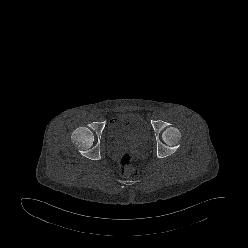 Brodie abscess- femoral neck (Radiopaedia 53862-59966 Axial bone window 137).jpg