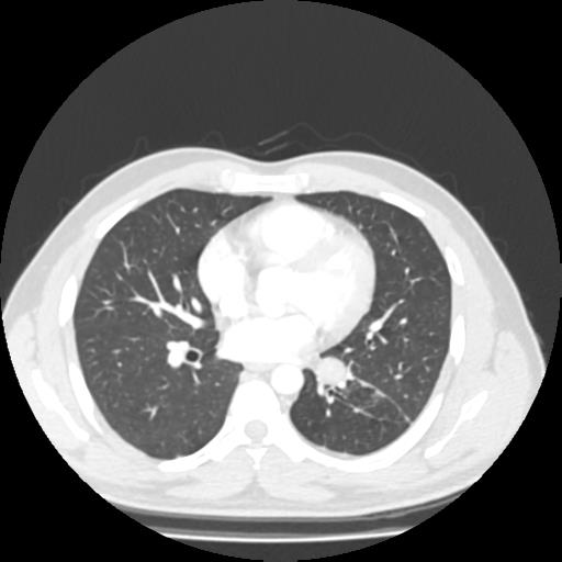 Bronchial carcinoid (Radiopaedia 80013-93291 Axial lung window 66).jpg