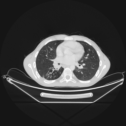 Bronchial carcinoid tumor (Radiopaedia 57187-64090 Axial lung window 42).jpg
