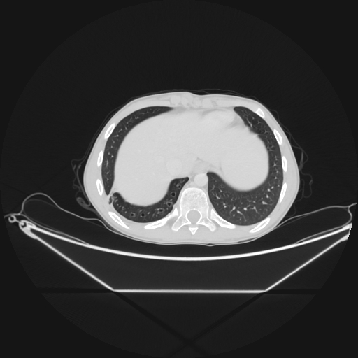 Bronchial carcinoid tumor (Radiopaedia 57187-64090 Axial lung window 66).jpg
