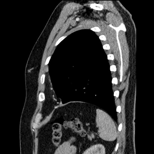 Bronchial carcinoid tumor (Radiopaedia 67377-76764 E 57).jpg