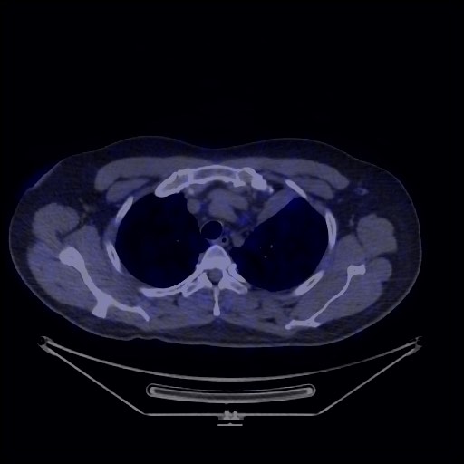 Bronchial carcinoid tumor (Radiopaedia 67377-76765 68Ga-DOTATATE PET-CT 22).jpg