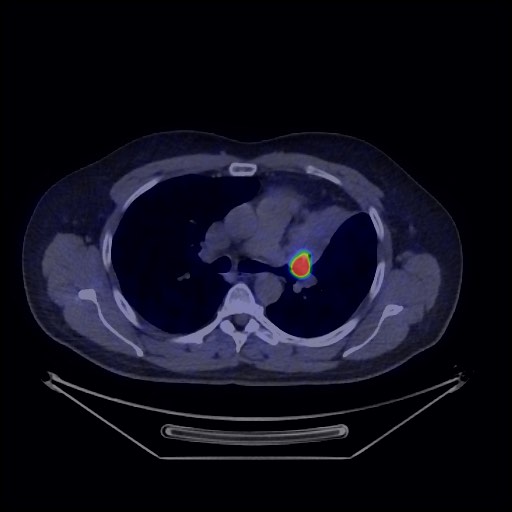 Bronchial carcinoid tumor (Radiopaedia 67377-76765 68Ga-DOTATATE PET-CT 29).jpg