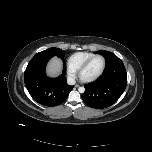 File:Bronchial carcinoid tumor (Radiopaedia 78272-90875 A 69).jpg