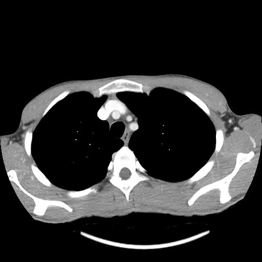 Bronchial carcinoid tumor causing right lower lobe collapse (Radiopaedia 83495-98594 A 9).jpg
