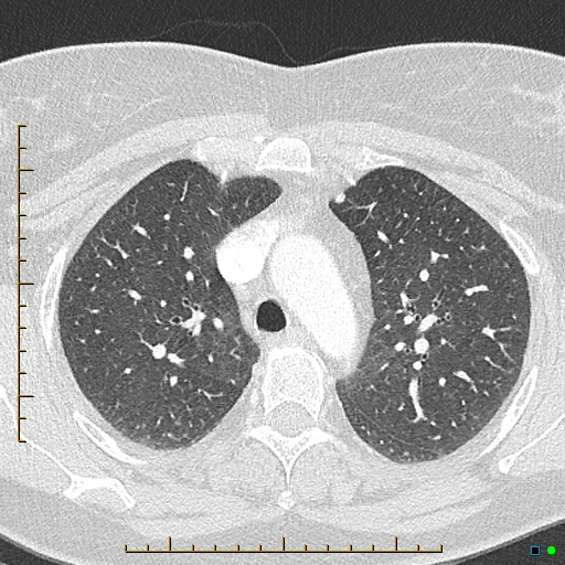 File:Bronchial diverticula (Radiopaedia 79512-92676 Axial lung window 50).jpg