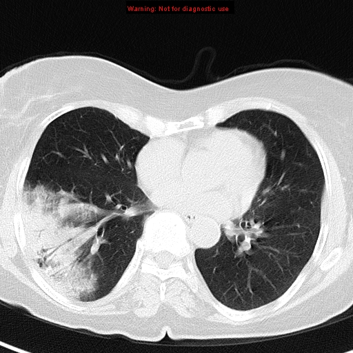 File:Bronchoalveolar carcinoma (BAC) (Radiopaedia 13436-13392 Axial lung window 31).jpg