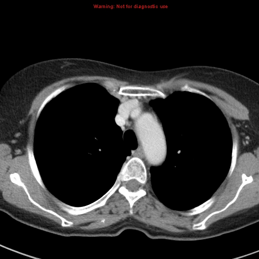 File:Bronchoalveolar carcinoma (BAC) (Radiopaedia 13436-13392 B 15).jpg