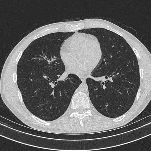 Bronchocele (Radiopaedia 60676-68429 Axial lung window 44).jpg
