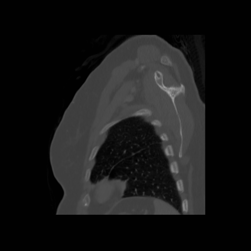 Bronchogenic carcinoma (Radiopaedia 73497-84262 Sagittal bone window 129).jpg