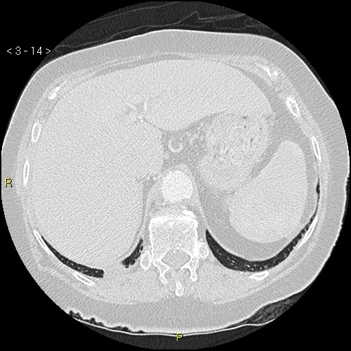 File:Bronchogenic carcinoma as an incidental finding (Radiopaedia 16453-16130 Axial lung window 14).jpg
