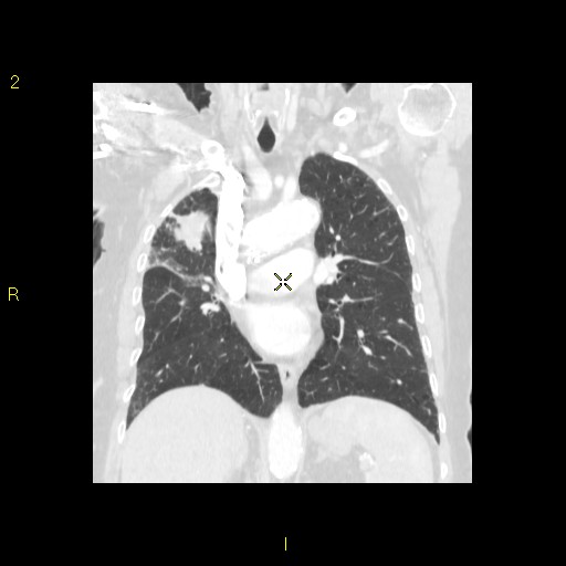 File:Bronchogenic carcinoma as an incidental finding (Radiopaedia 16453-16130 Coronal lung window 27).jpg