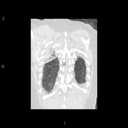 File:Bronchogenic carcinoma as an incidental finding (Radiopaedia 16453-16130 Coronal lung window 42).jpg