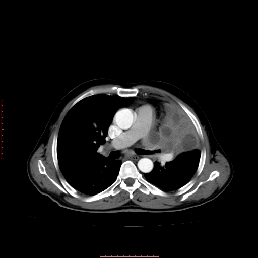 File:Bronchogenic carcinoma with left atrial large deposit - T4N3M1a (Radiopaedia 42316-45428 A 14).jpg