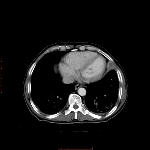 File:Bronchogenic carcinoma with left atrial large deposit - T4N3M1a (Radiopaedia 42316-45428 A 22).jpg