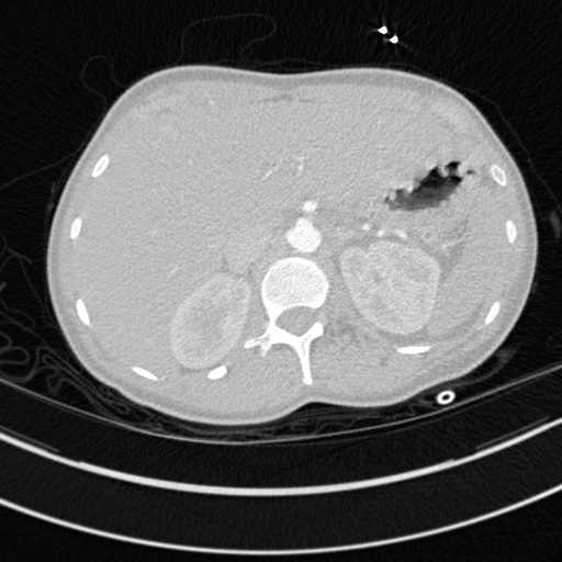 File:Bronchogenic cyst (Radiopaedia 77801-90071 Axial lung window 89).jpg