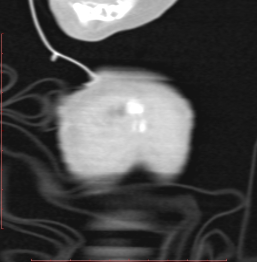 Bronchogenic cyst (Radiopaedia 78599-91409 Coronal lung window 3).jpg