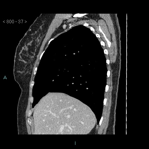 Bronchogenic cyst - posterior mediastinal (Radiopaedia 43885-47364 B 24).jpg