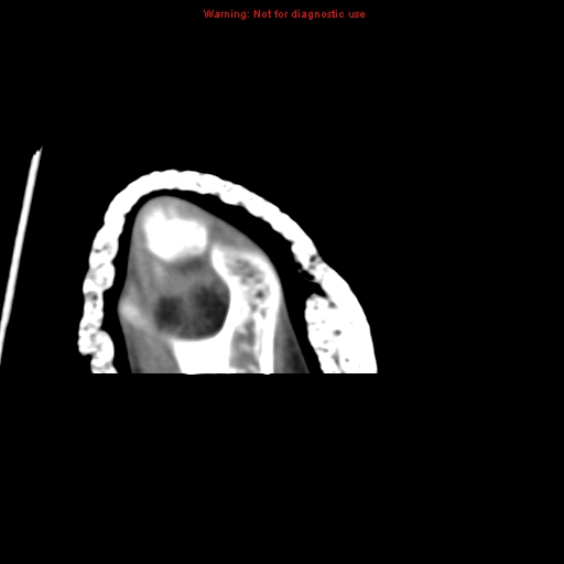 File:Brown tumor (Radiopaedia 12460-12694 Axial non-contrast 143).jpg