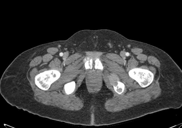 Brown tumors compressing the spinal cord (Radiopaedia 68442-77988 E 130).jpg