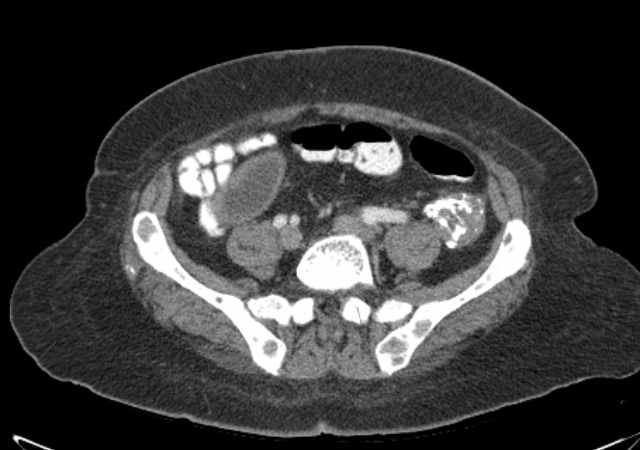 File:Brown tumors compressing the spinal cord (Radiopaedia 68442-77988 E 88).jpg