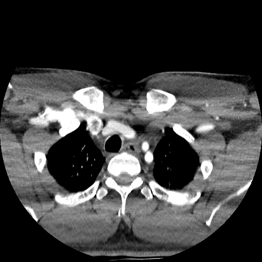 Buccal fat pad arteriovenous malformation (Radiopaedia 70936-81144 D 22).jpg