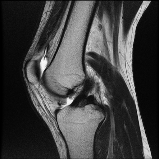 File:Bucket-handle meniscus tear (Radiopaedia 65700-74809 Sagittal T2 13).jpg