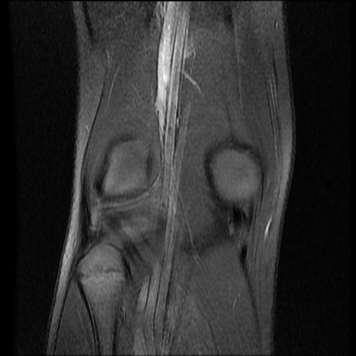 File:Bucket handle tear - lateral meniscus (Radiopaedia 72124-82634 Coronal PD fat sat 14).jpg